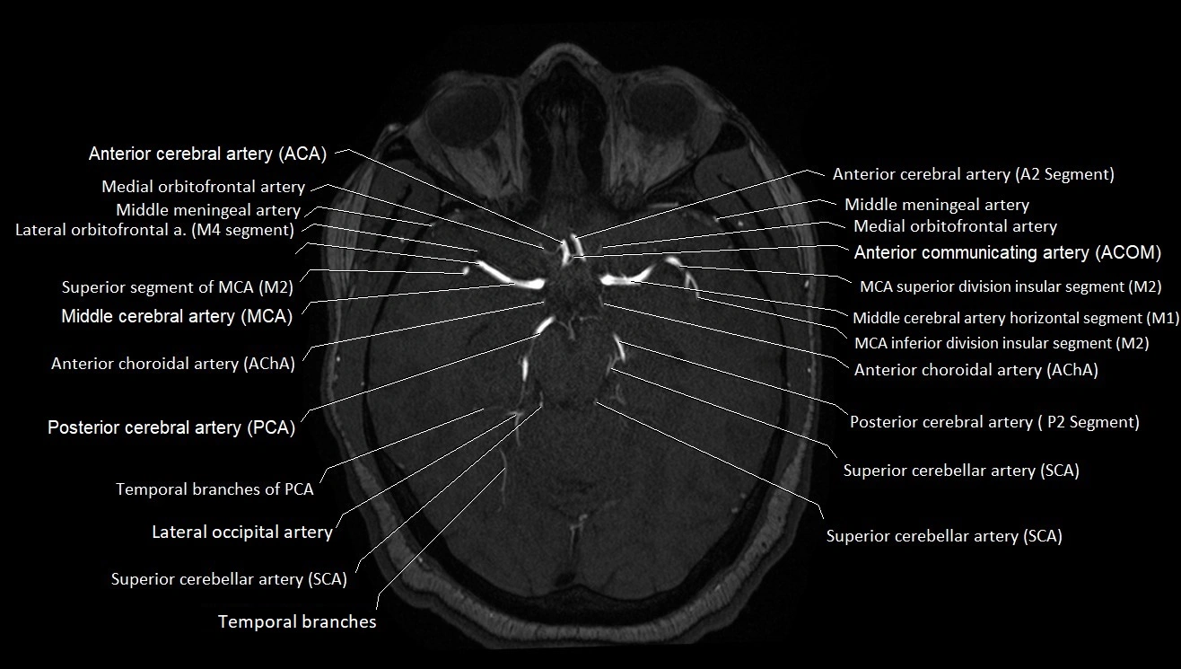 MRA brain (cerebral arteries) anatomy axial 3T image 16.webp